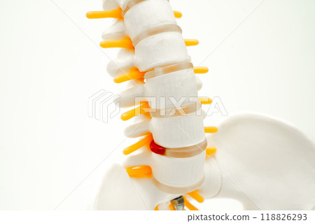 Spinal nerve and bone, Lumbar spine displaced herniated disc fragment, Model for treatment medical in the orthopedic department. 118826293