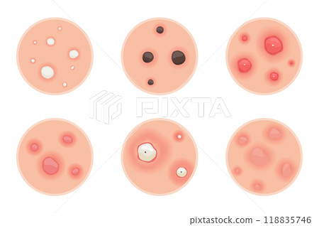 Understanding Type of Acne A Comprehensive Visual Guide for Everyone Understanding Type of Acne A Comprehensive Visual Guide for Everyone 118835746