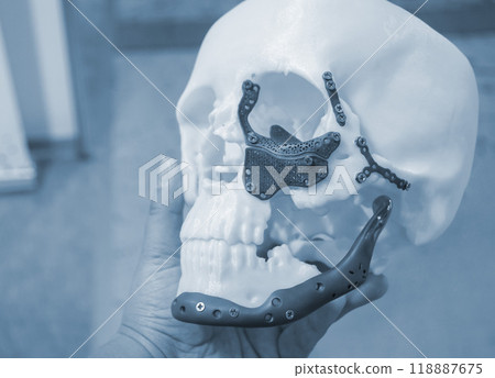 Man holding in hand proto-human skull from white plastic with titanium implants in form of plates and surgical templates printed on 3D printer. Biointegrated prosthesis 118887675