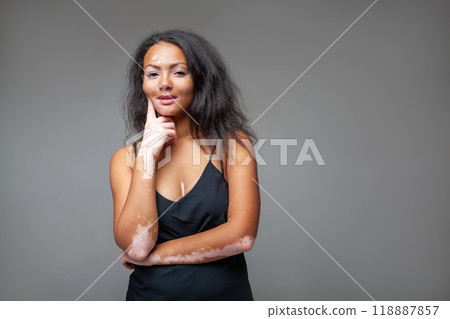 Smiling fashion model with vitiligo skin issue Smiling fashion model with vitiligo skin issue 118887857