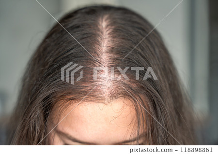 Close-up view of the head with traces of blood from injections after mesotherapy, treatment of alopecia 118898861