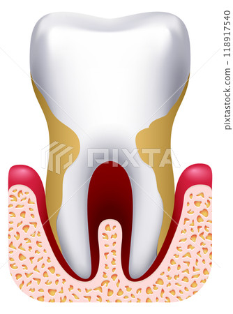 Periodontitis drawing. Dental clinic treatment. Tooth disease 118917540