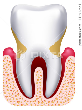Periodontal disease. Tooth pain. Dental infection drawing Periodontal disease. Tooth pain. Dental infection drawing 118917541