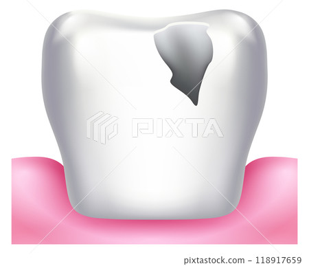Broken tooth with hole in enamel. Dental treatment illustration 118917659