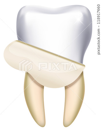 Tooth whitening. Dental hygiene cleaning procedure illustration Tooth whitening. Dental hygiene cleaning procedure illustration 118917660