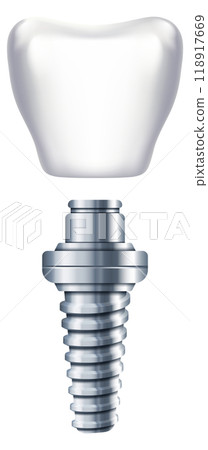 Dental implant scheme. Tooth replacement. Orthodontic illustration 118917669