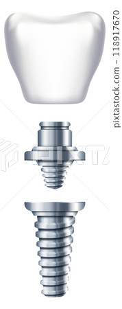 Implant parts illustration. Dental prosthesis. Orthodontic scheme 118917670