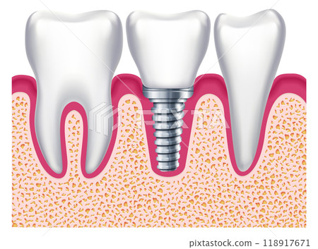 Implant among healthy teeth. Dental treatment. Stomatology prosthesis Implant among healthy teeth. Dental treatment. Stomatology prosthesis 118917671