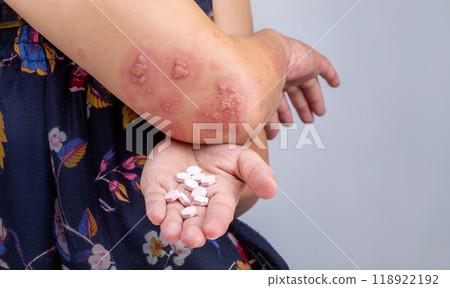 Shingles, Zoster or Herpes Zoster symptoms on arm. Shingles, Zoster or Herpes Zoster symptoms on arm. 118922192