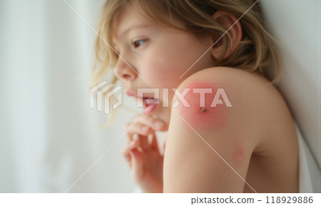 Detailed view of tick feeding on woman arm skin causing irritation and redness, potential Lyme disease transmission, health care concerns, nature-related risk Detailed view of tick feeding on woman arm skin causing irritation and redness, potential Lyme disease transmission, health care concerns, nature-related risk 118929886