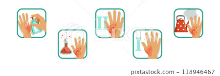 Hand Burn Degree and First Aid Procedure Vector Set 118946467