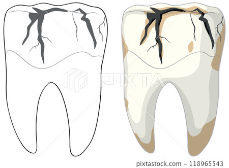 Cracked Tooth Illustration in Vector Format 118965543