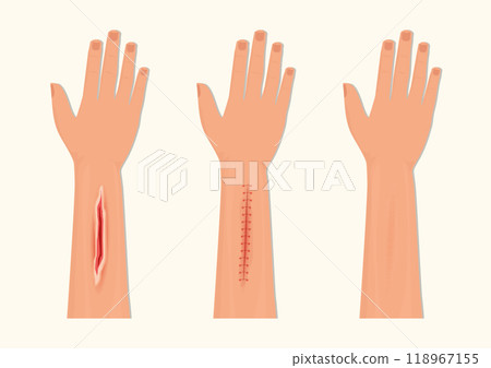 Wound Suturing and Suture Care. 118967155