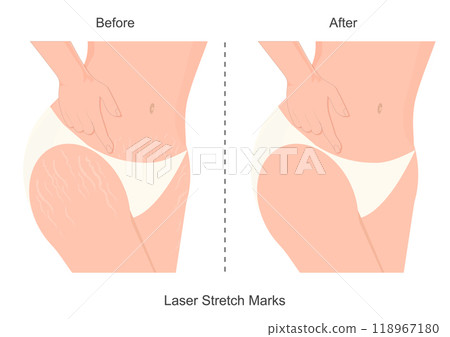 Before and after laser stretch marks removal. 118967180