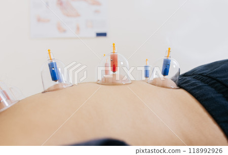 Close-up of suction cups on the patient back, Acupuncture cupping on the back of a person lying down. Patient lying down with suction cups on her back. Physiotherapy cupping on a lying patient Close-up of suction cups on the patient back, Acupuncture cupping on the back of a person lying down. Patient lying down with suction cups on her back. Physiotherapy cupping on a lying patient 118992926