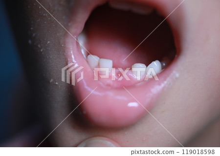 Change teeth 119018598