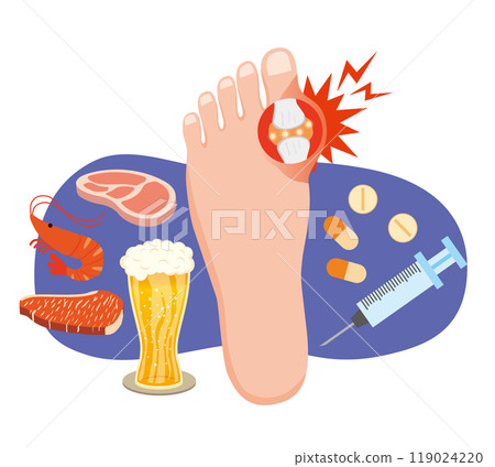 痛風發作的影像說明 痛風發作的影像說明 119024220