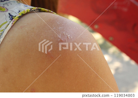 pimple on the forearm. Pimples comedones on shoulder forearm girl close-up pimple on the forearm. Pimples comedones on shoulder forearm girl close-up 119034803