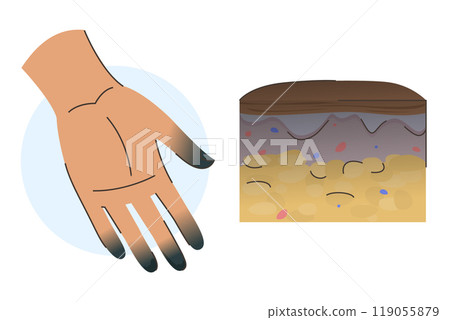 Third frostbite stage infographic vector isolated Third frostbite stage infographic vector isolated 119055879