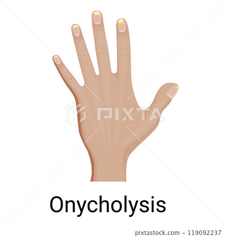 Nail Onycholysis vector illustration design. 119092237