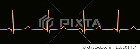 ECG of type 3 long QT syndrome, 3D illustration ECG of type 3 long QT syndrome, 3D illustration 119101414