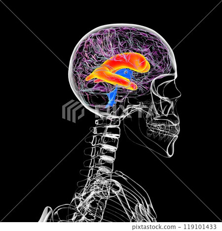 Enlarged lateral ventricles of the brain, 3D illustration Enlarged lateral ventricles of the brain, 3D illustration 119101433