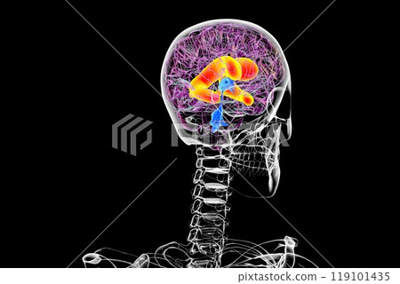 Enlarged lateral ventricles of the brain, 3D illustration Enlarged lateral ventricles of the brain, 3D illustration 119101435