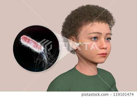 Otitis media in a child, 3D illustration Otitis media in a child, 3D illustration 119101474