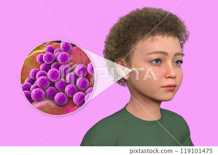 Otitis media in a child, 3D illustration Otitis media in a child, 3D illustration 119101475