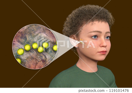 Otitis media in a child, 3D illustration Otitis media in a child, 3D illustration 119101476