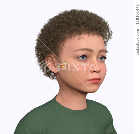 Otitis media in a child, 3D illustration Otitis media in a child, 3D illustration 119101478