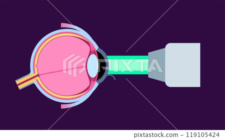 Lasik eye surgery Lasik eye surgery 119105424