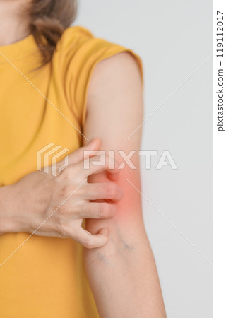 woman itching and scratching itchy arm. Sensitive Skin Allergic reaction to insect bite, food, drug dermatitis. Dermatology, Leprosy day, Systemic lupus erythematosus, Allergy symptoms and rash Eczema woman itching and scratching itchy arm. Sensitive Skin Allergic reaction to insect bite, food, drug dermatitis. Dermatology, Leprosy day, Systemic lupus erythematosus, Allergy symptoms and rash Eczema 119112017