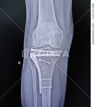 Structure of knee and rx-ray image of knee, tibia fracture with post operation internal fixation. Structure of knee and rx-ray image of knee, tibia fracture with post operation internal fixation. 119112388