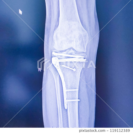 Structure of knee and rx-ray image of knee, tibia fracture with post operation internal fixation. 119112389