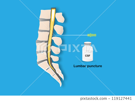 Lumbar puncture procedure illustration 119127441