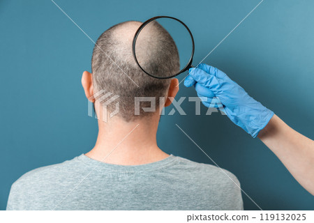 A man with alopecia on his head is being examined by a trichologist. The doctor's hand holds a magnifying glass at the center of baldness. Back view. The concept of baldness and alopecia 119132025