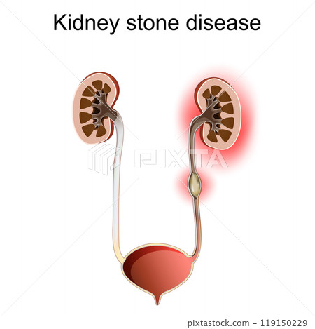 Kidney stone disease. Urolithiasis. Renal calculus 119150229