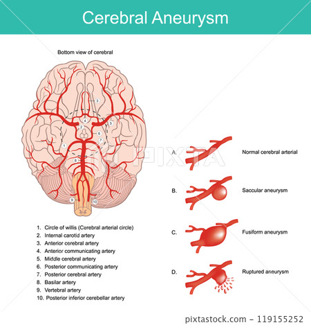 Cerebral Aneurysm. A bulging artery weakened area in the wall of an artery in the brain. Cerebral Aneurysm. A bulging artery weakened area in the wall of an artery in the brain. 119155252