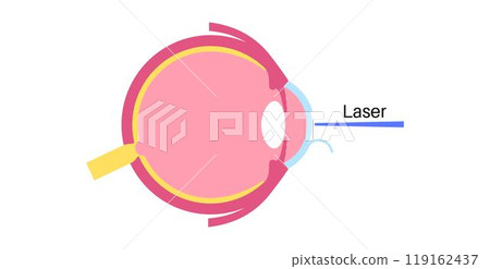 Lasik eye surgery 119162437