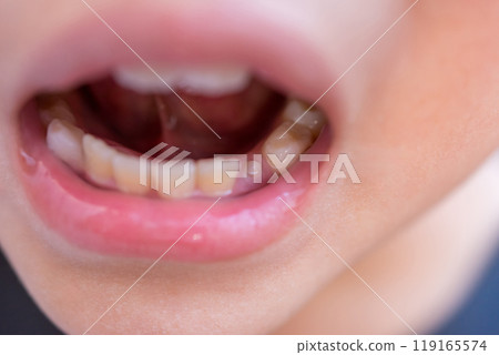 A 10-year-old child whose lower canine teeth have begun to grow in 119165574