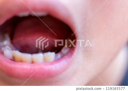A 10-year-old child whose lower canine teeth have begun to grow in 119165577