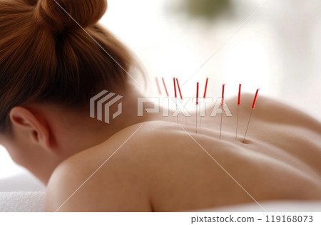 Holistic wellness: ancient practice of acupuncture, delicate placement of needles on the human body, emphasizing balance, healing, and the therapeutic benefits of this traditional method. Holistic wellness: ancient practice of acupuncture, delicate placement of needles on the human body, emphasizing balance, healing, and the therapeutic benefits of this traditional method. 119168073
