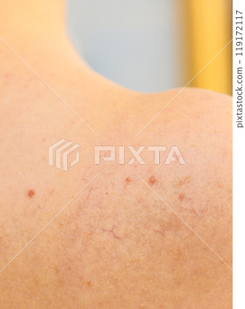 Ski with dilated capillaries ad red spots 119172117