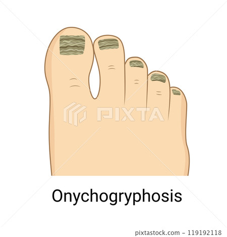 Toenail onychogryphosis, nail pathology, Ram Horn Nails Toenail onychogryphosis, nail pathology, Ram Horn Nails 119192118