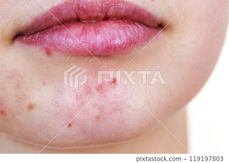 Female face with acne skin problem Female face with acne skin problem 119197803