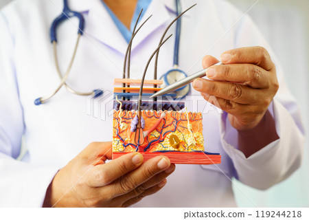 Hair transplant, Asian dermatologist doctor holding skin structure anatomy model for treatment in hospital. 119244218