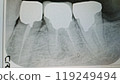 X-ray of teeth (lower molar with filling)_1441 119249494