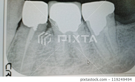 牙齒X光照片（下臼齒補牙）_1441 119249494