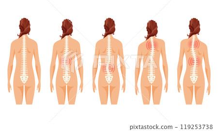 This article covers the different types of scoliosis affecting individuals of all ages 119253738